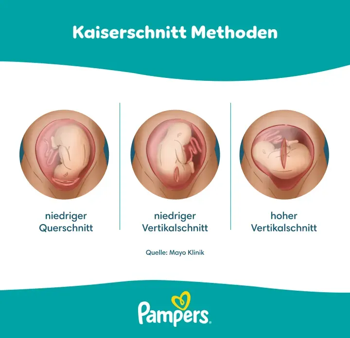 Kaiserschnitt methoden Kaiserschnitt methoden