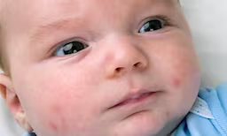 Baby with acne