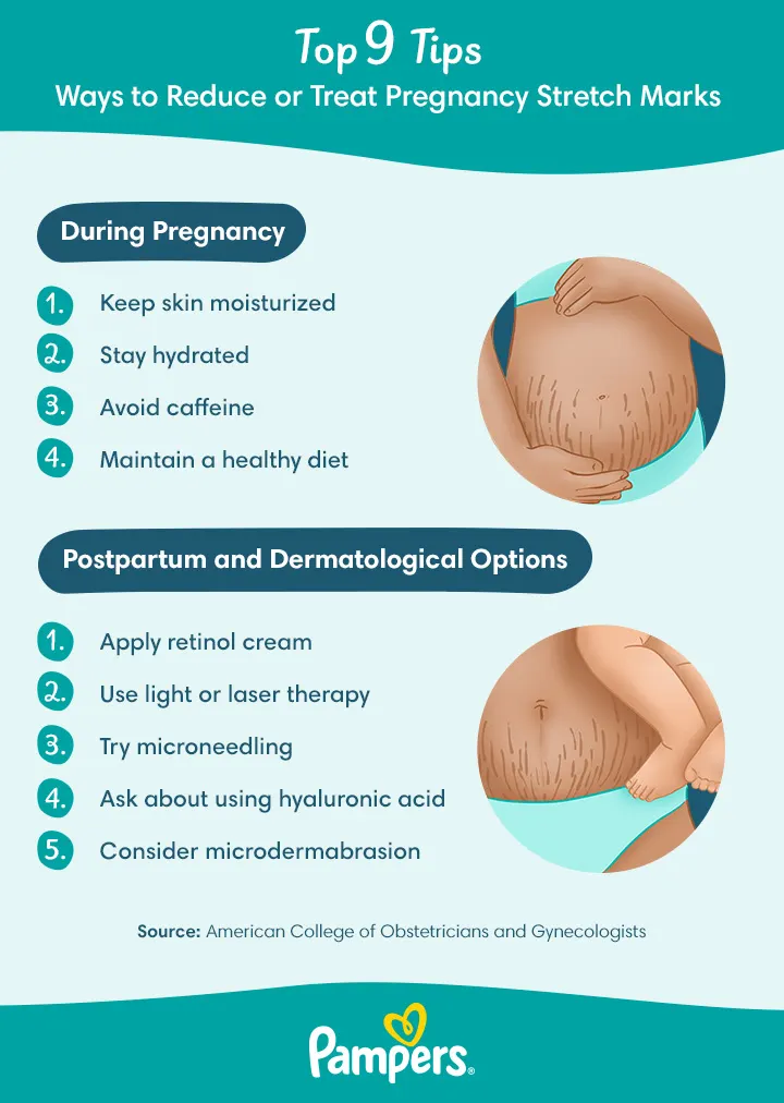 Tips for reducing pregnancy stretch marks