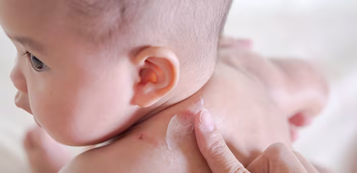 Picaduras de mosquitos en bebés; descubre cómo tratarlas.