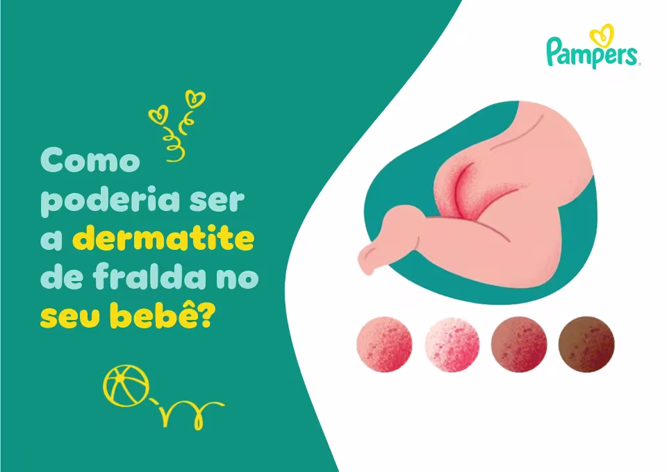 Como poderia ser a dermatite de fralda no seu bebê?
