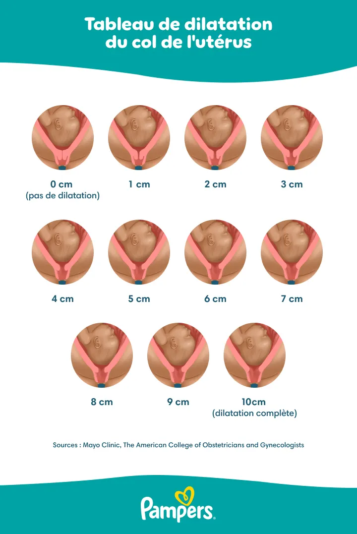 Tableau de la dilatation du col de l'utérus