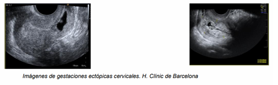 ECOGRAFIA-EMBARAZO-ECTOPICO-CERVICAL