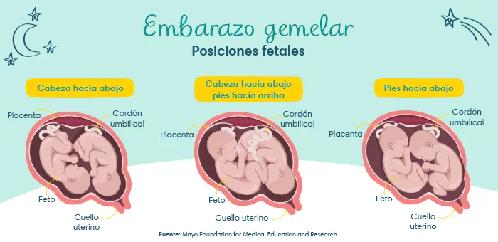 Embarazo gemelar: Posiciones fetales