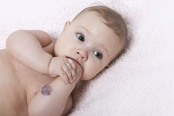 Manchas de nacimiento o hemangiomas en bebés