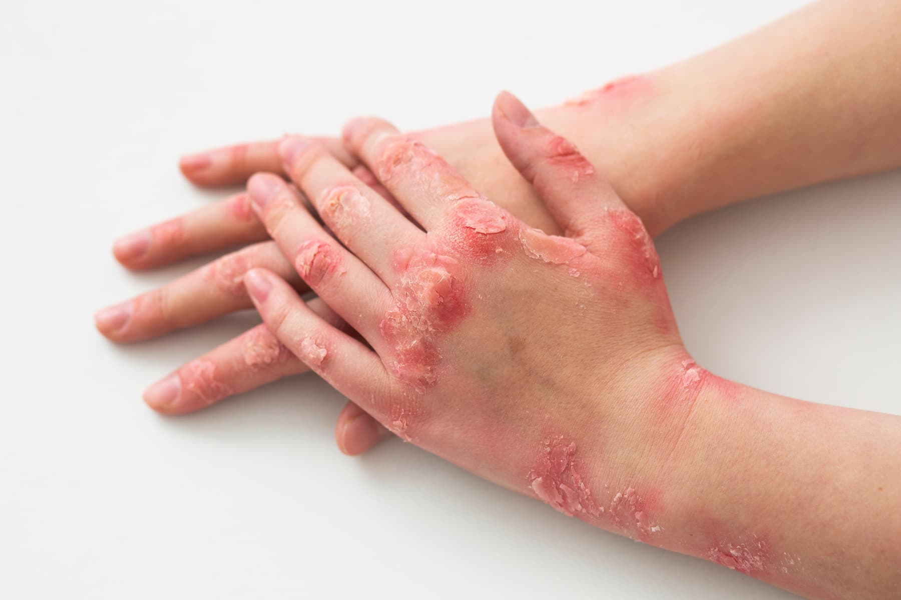 Łuszczyca skóry, paznokci, stawów: przyczyny, objawy i leczenie