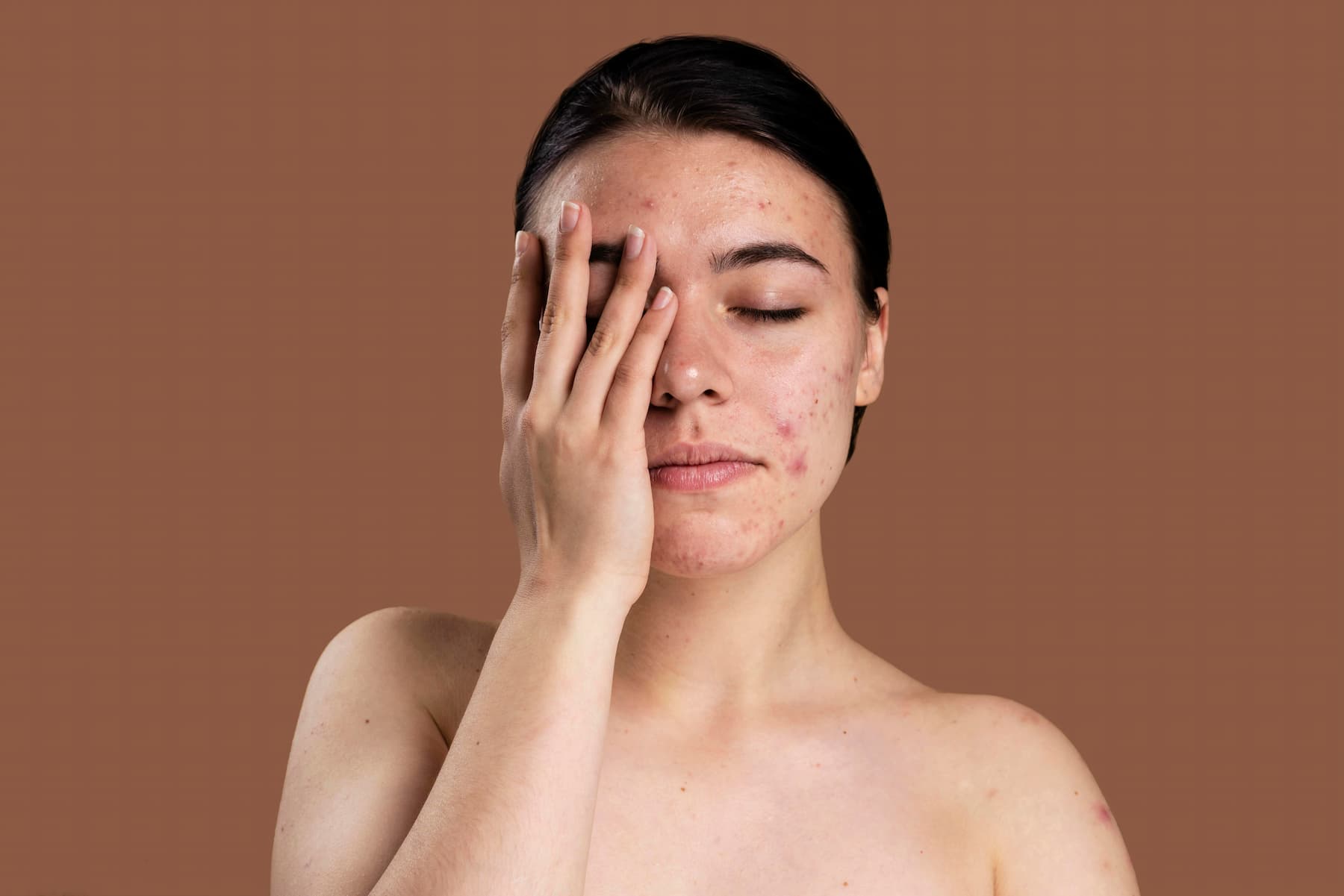 Acne: common, hormonal, rosacea and others [symptoms, treatment].