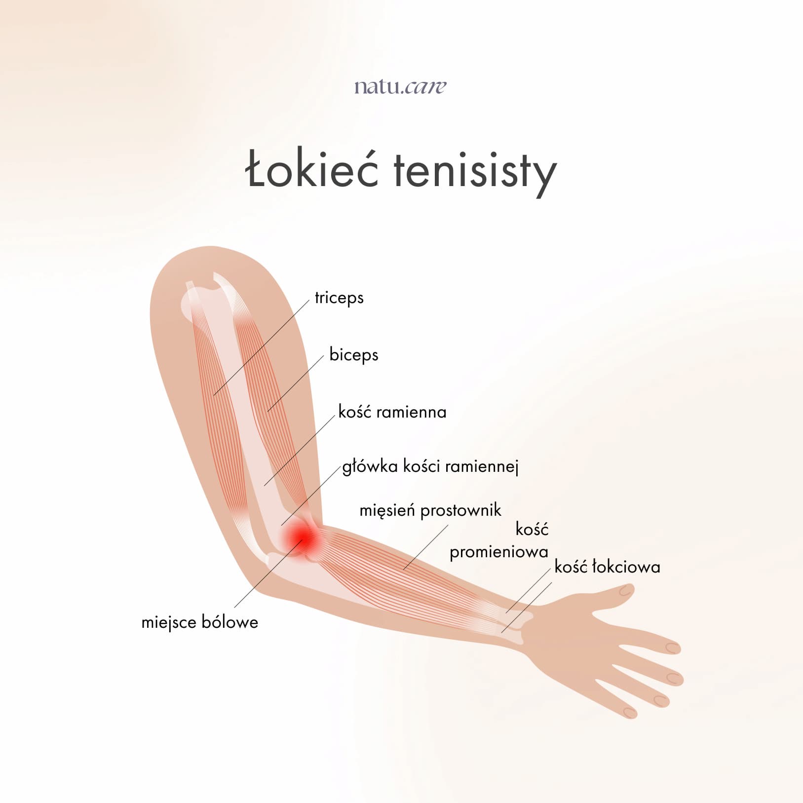 Łokieć tenisisty