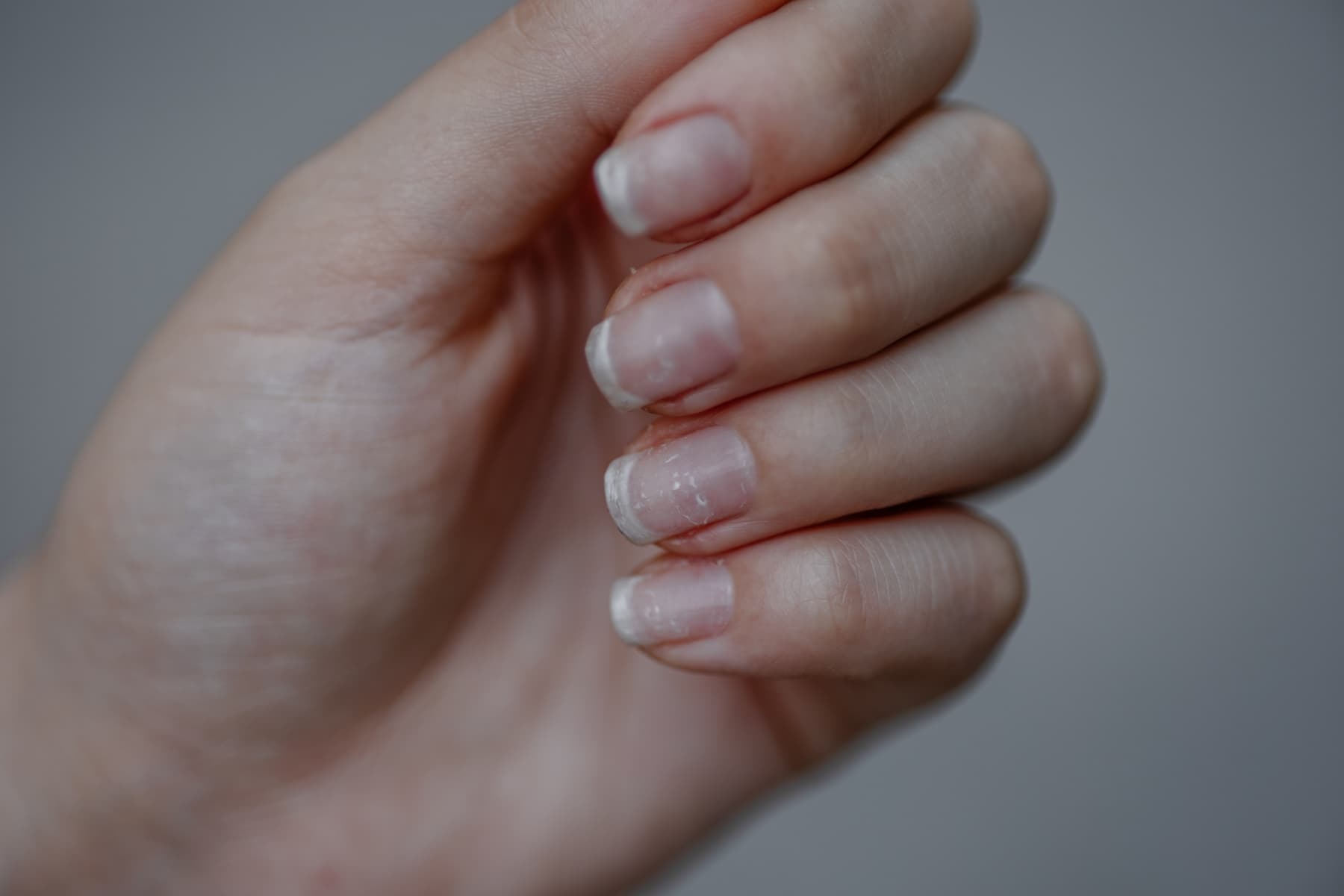 Białe plamki na paznokciach: co oznaczają, przyczyny, co jeść
