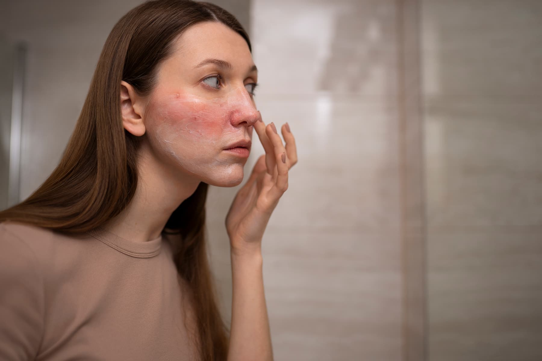 Acne rosacea: causes, symptoms, treatment, cosmetics, diet