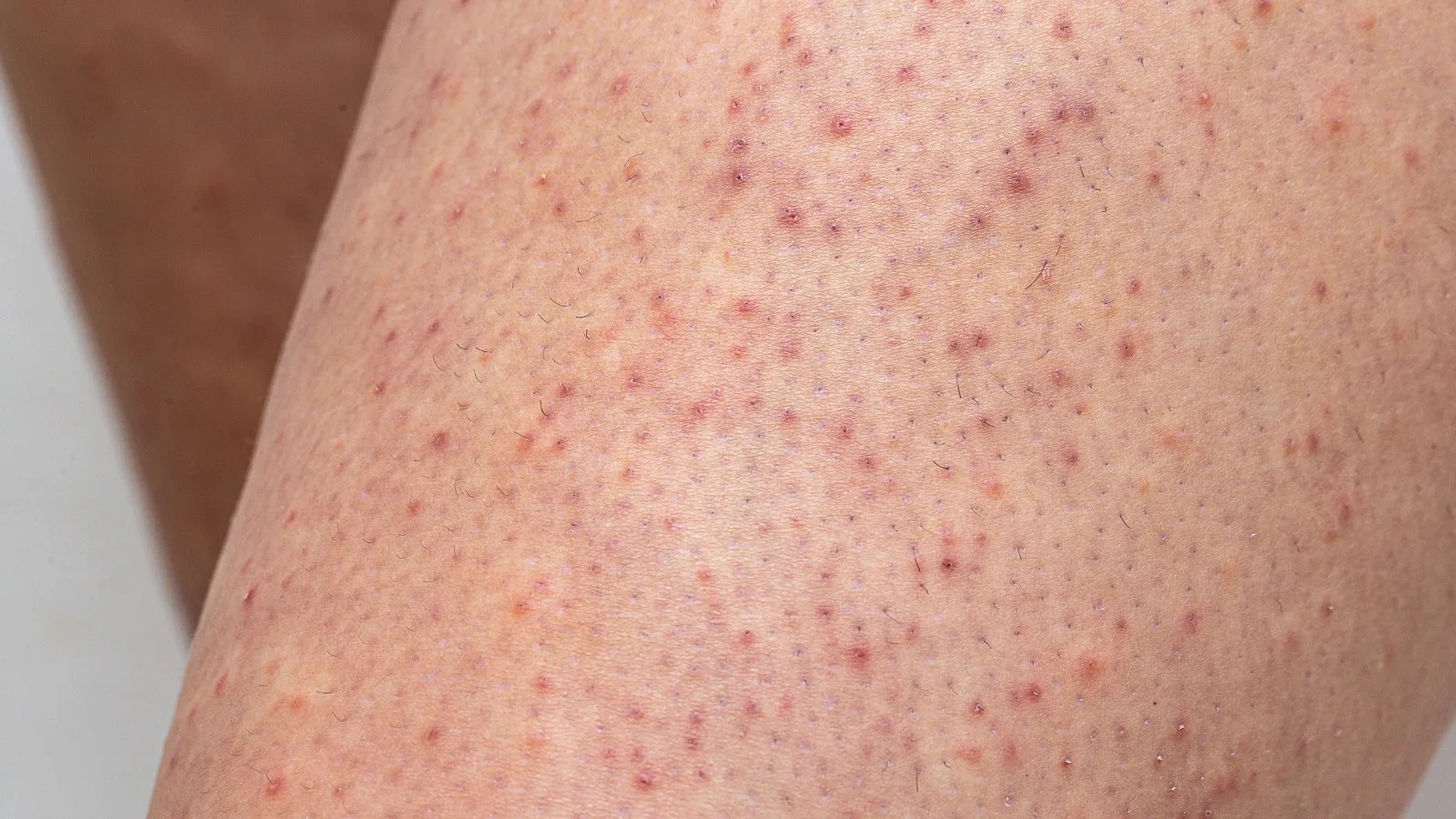 White blotchy rash on legs see picture