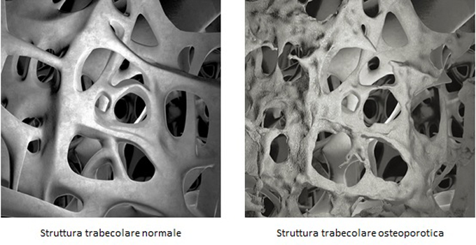 Osteoporosi immagine web