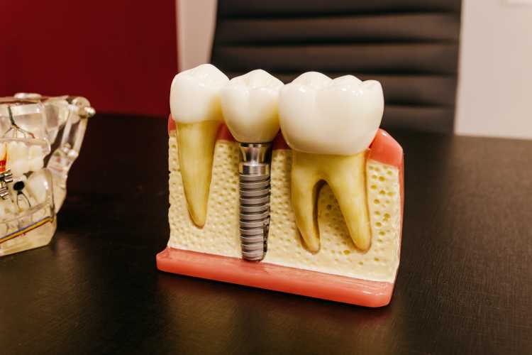 Guía básica de los implantes dentales 