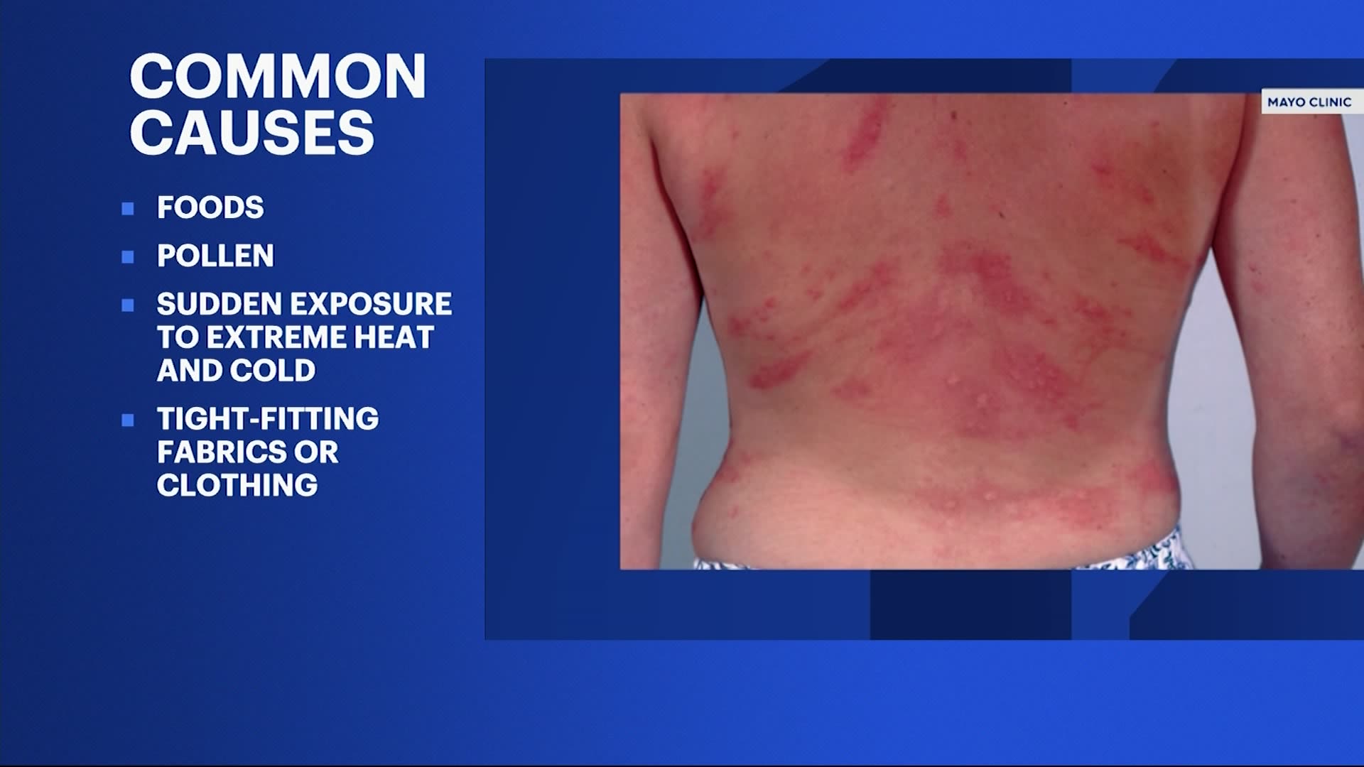 Seasonal hives on the rise ahead of the summer