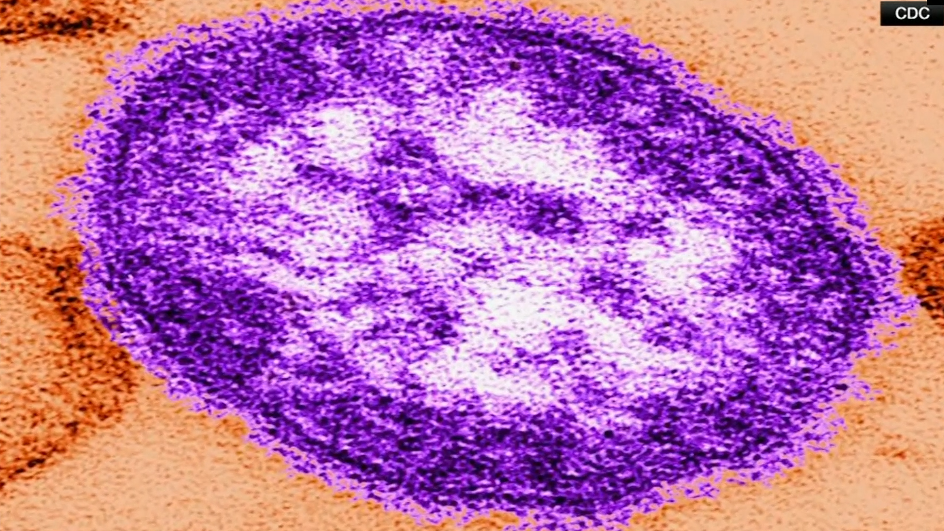 582025WCmeasles_2025-05-08-06-10-09