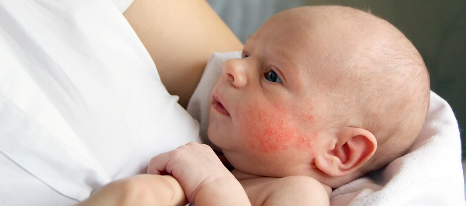 eczema treatment baby nhs