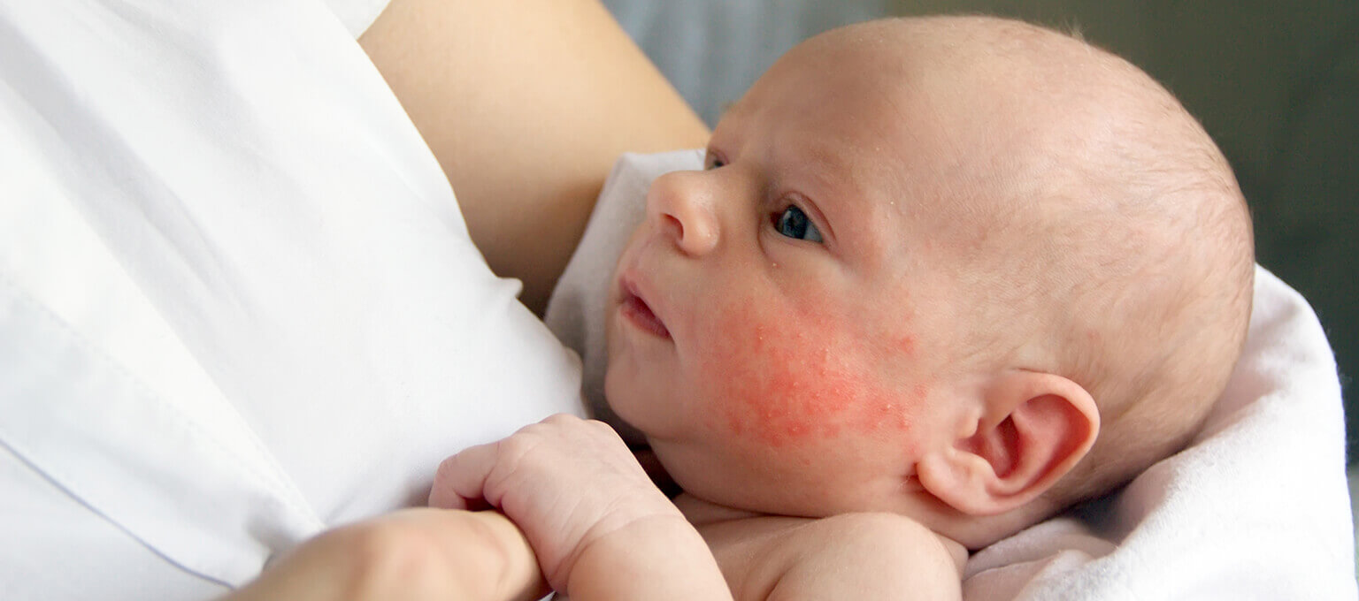 Red dry skin patches on babys face