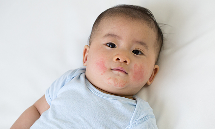 What Is Slapped Cheek Syndrome B19)? |