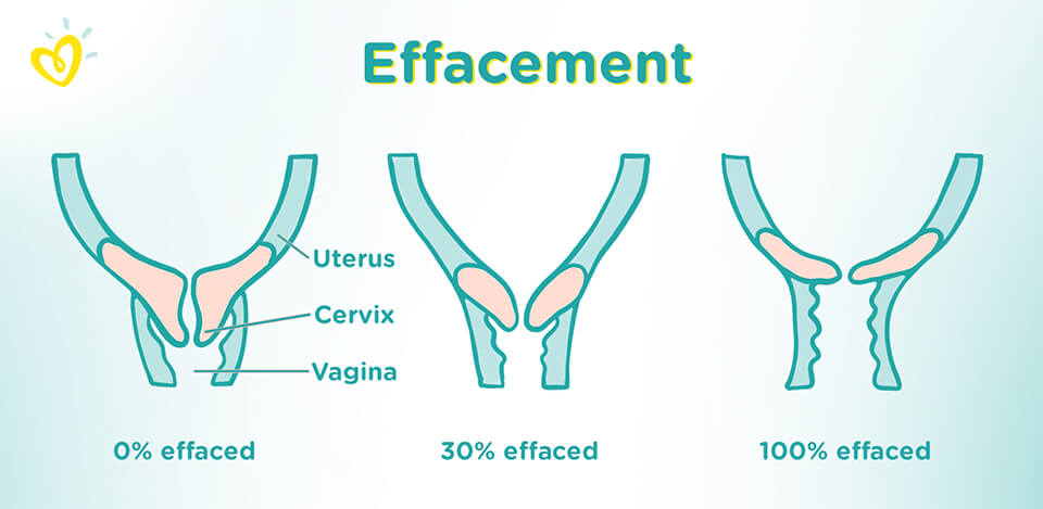 What Is Effacement The Latent Phase of Labour Pampers