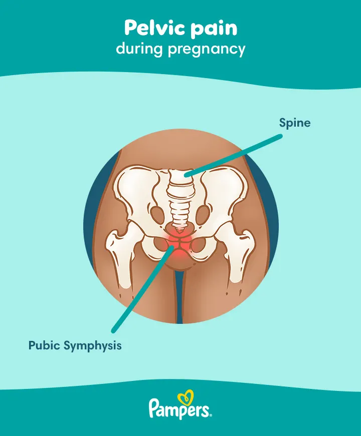 Pelvic Girdle Pain Pgp Spd —symptoms And Treatment Pampers