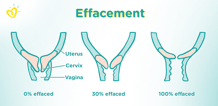 What Is Effacement The Latent Phase Of Labour Pampers