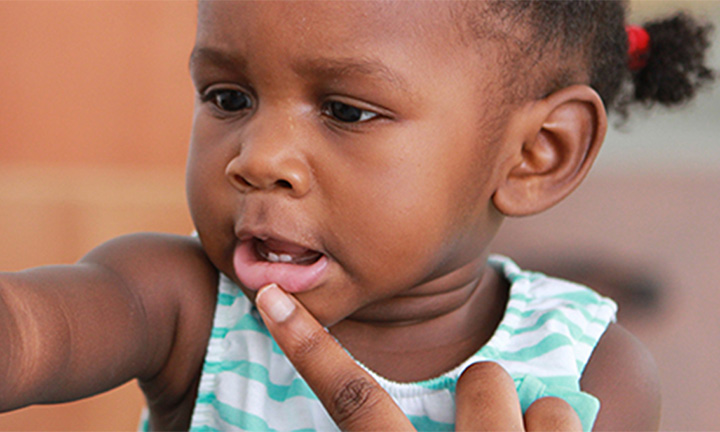 chipped baby tooth 1 year old