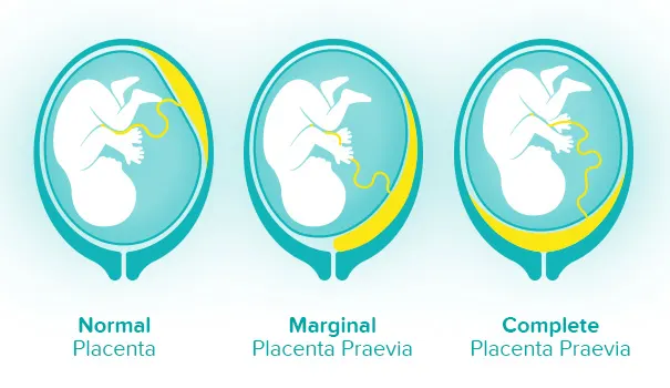 Types of Placenta Praevia 