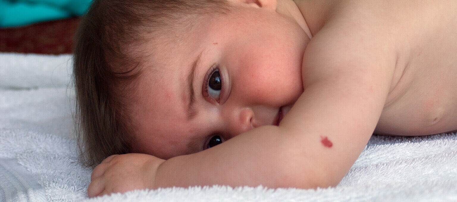 Baby Birthmarks Types And Causes Pampers