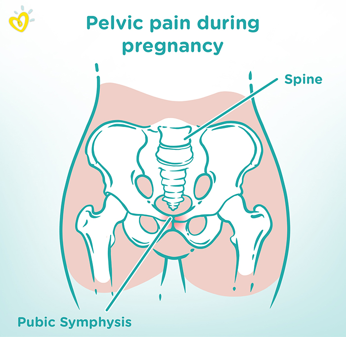 Pubic symphysis dysfunction (SPD) during pregnancy