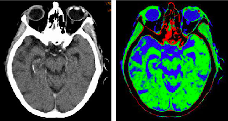 Two CT scan images of the brain