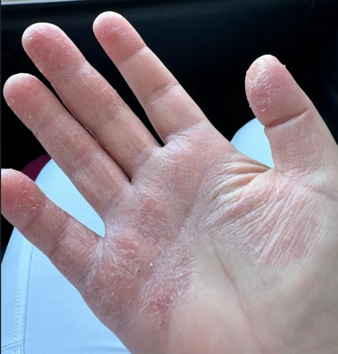 El aumento de la dermatitis durante la pandemia de COVID-19 Causas, impacto psicológico y tipos de dermatitis