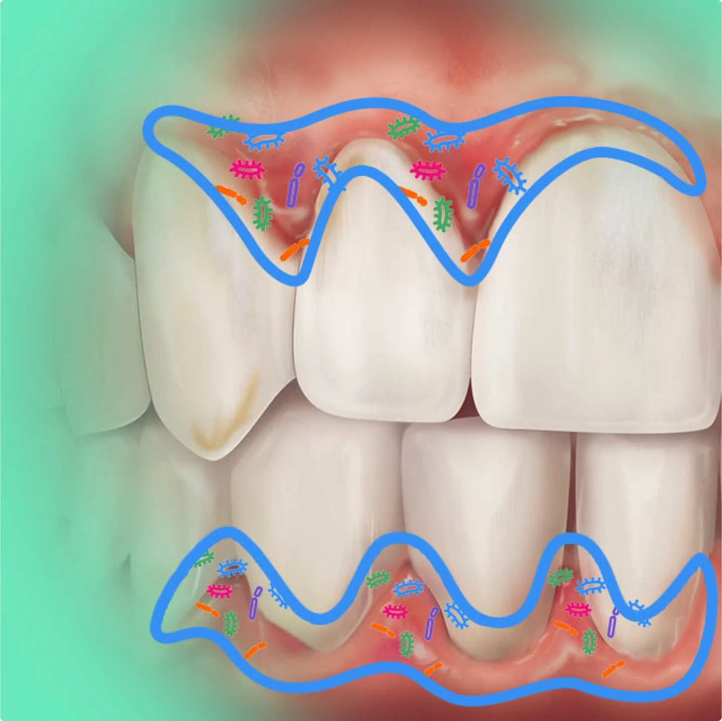 Diş eti hastalığının sağlıklı dişten gingivitise, periodontitise ve ileri periodontitise görsel ilerlemesi  