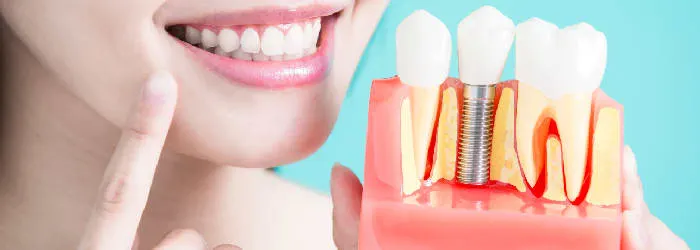 Diş İmplantı Ve Diş Eti Hastalığı: Bilmeniz Gerekenler article banner
