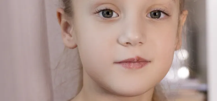 Yeni yürümeye başlayan çocuklarda uçuk 