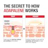 NTG_Adapalene_EDI_3_STS_Text.webp