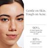 NA_US_NTG_AcneLegacy_OFAW_FF_9.1oz_ATF6_HUT_Amazon_3000x3000.webp