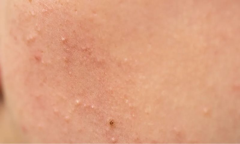 example of comedones and clogged pores on skin