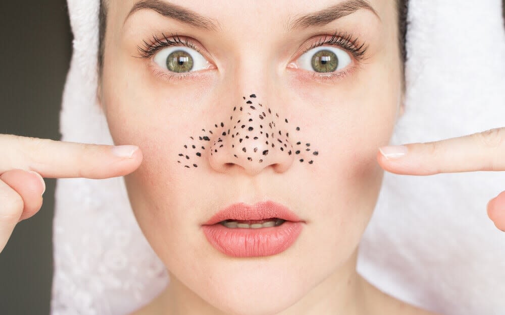 Eliminare i punti neri: come trattarli e prevenirne la comparsa - Hero Image - Neutrogena - it-IT