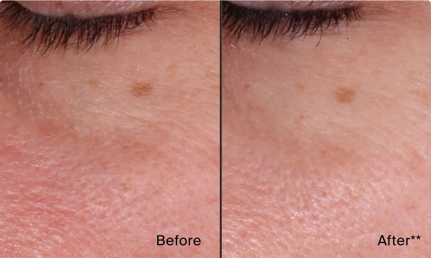 Image comparing before and after of using Neutrogena® Rapid Wrinkle Repair® products