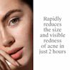 Neutrogena® Rapid Clear Stubborn Acne Spot Gel rapidly reduces the size and visible redness of acne in just 2 hours