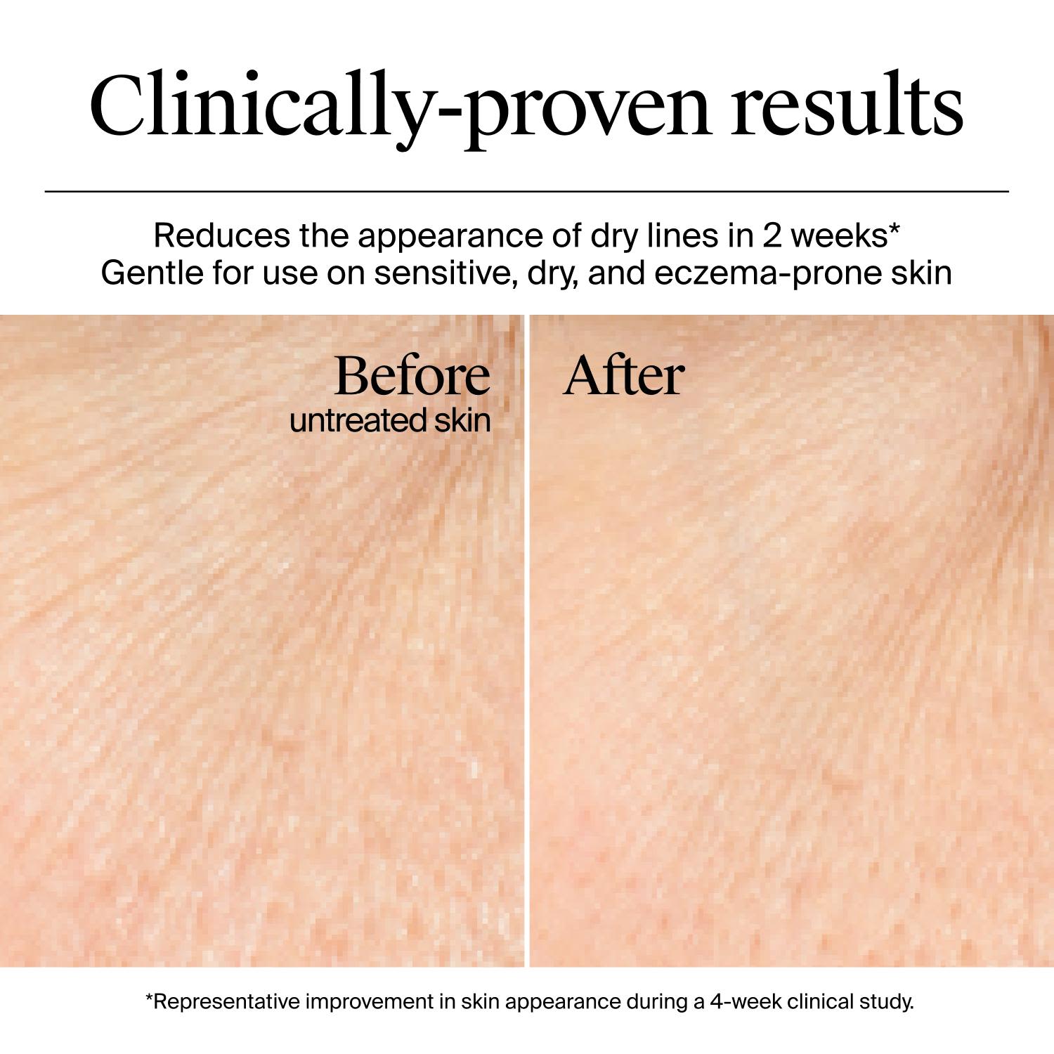 Résultats avant et après utilisation du gel-crème Hydro Boost de Neutrogena (sans parfum), après une étude clinique de 4 semaines