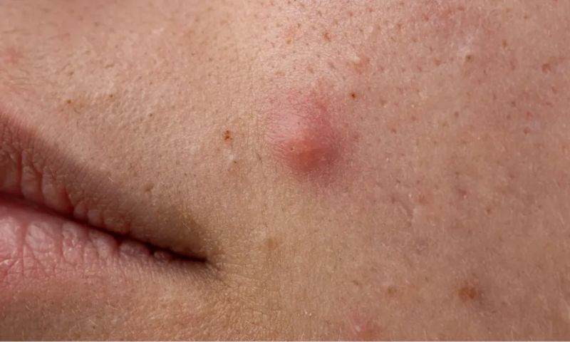 example of pustules and acne inflamed bumps on skin