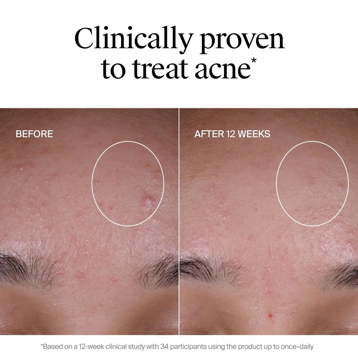 NA-US-NTG-Acne-Exfoliant-BA1-ATF7-Amazon-3000x3000.webp