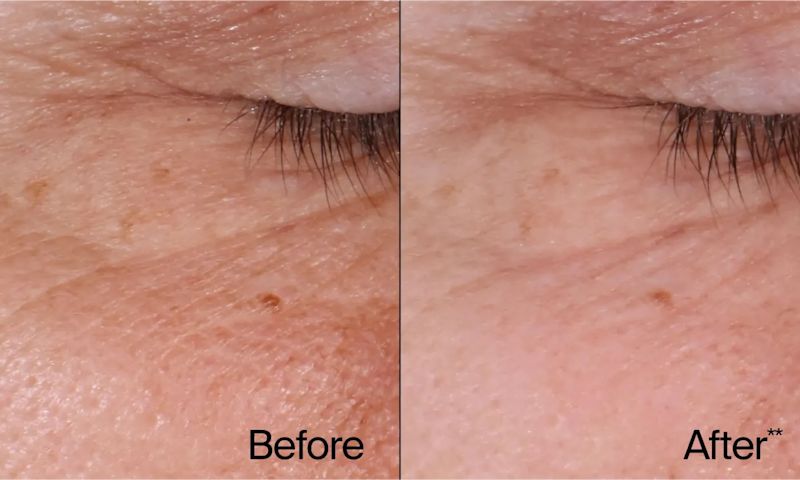 Image comparing before and after of using Neutrogena® Rapid Wrinkle Repair® products