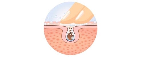 Acné: Descubre todo lo que deberías saber - Image 2 - Neutrogena - es-ES