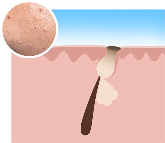 acne types blackheads