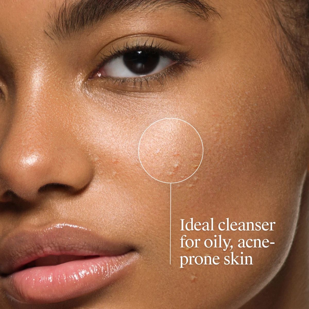 Closeup of model with oily acne prone skin highlighted as ideal cleanser.