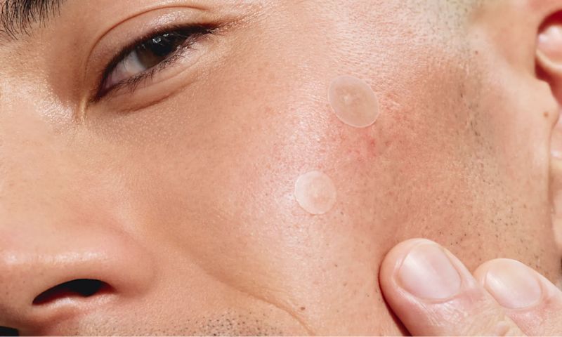 A close-up of a person's cheek with two Neutrogena® Mini Acne patches applied.