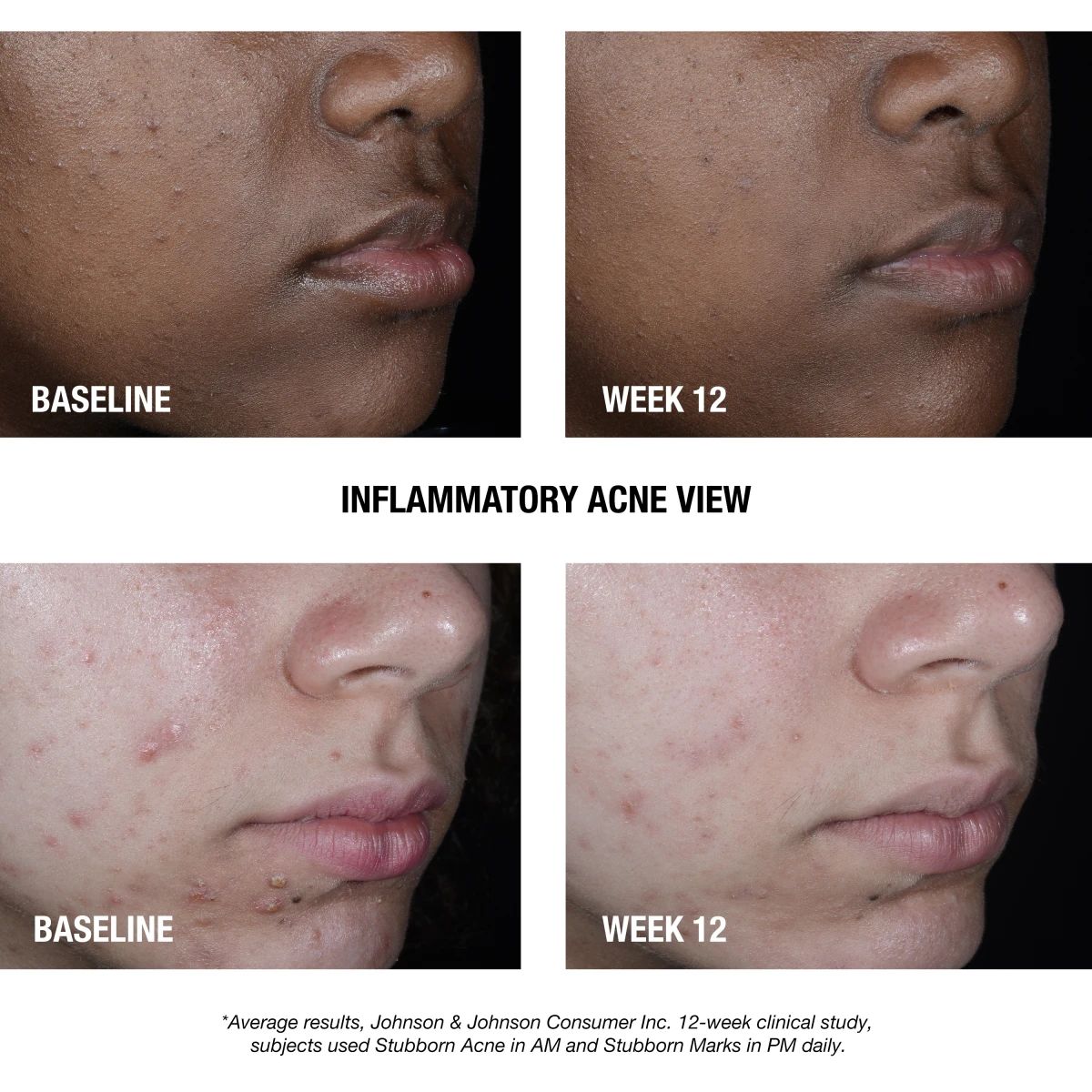 NTG_Stubborn_Am_PMTreatment_Before_After_Text.webp