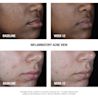 NTG_Stubborn_Am_PMTreatment_Before_After_Text.webp